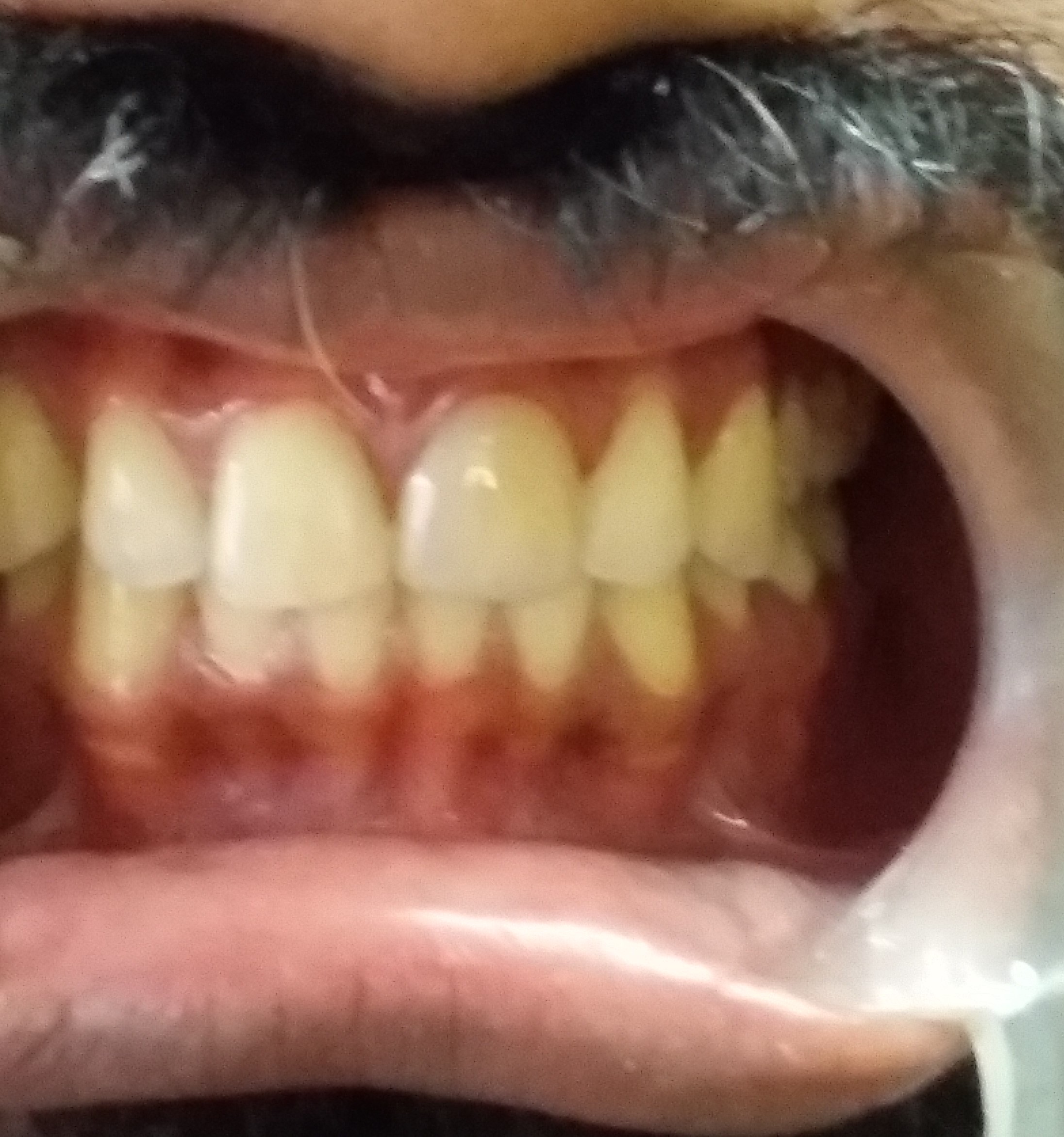 After treatment