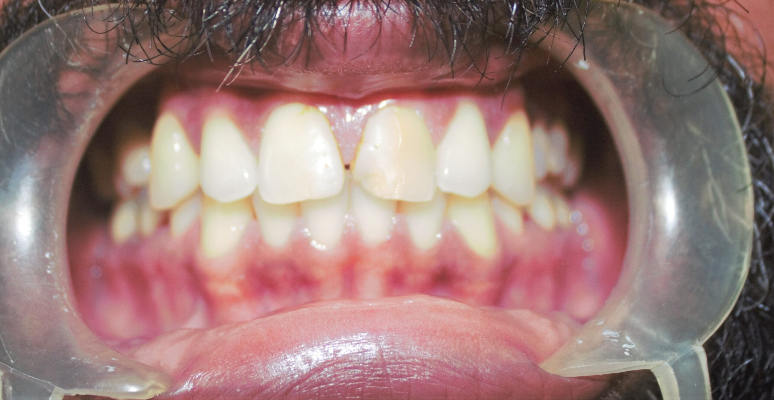 Before treatment