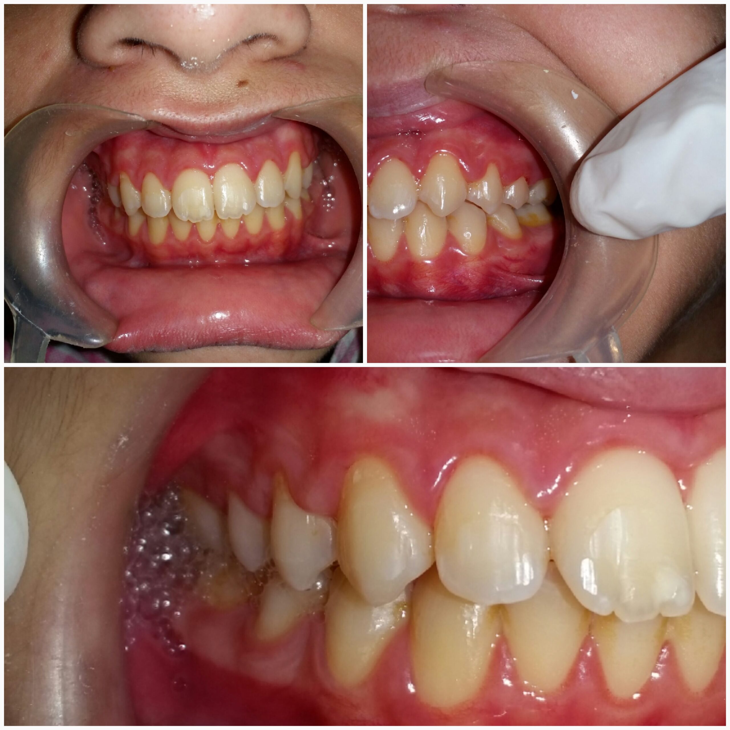 After treatment