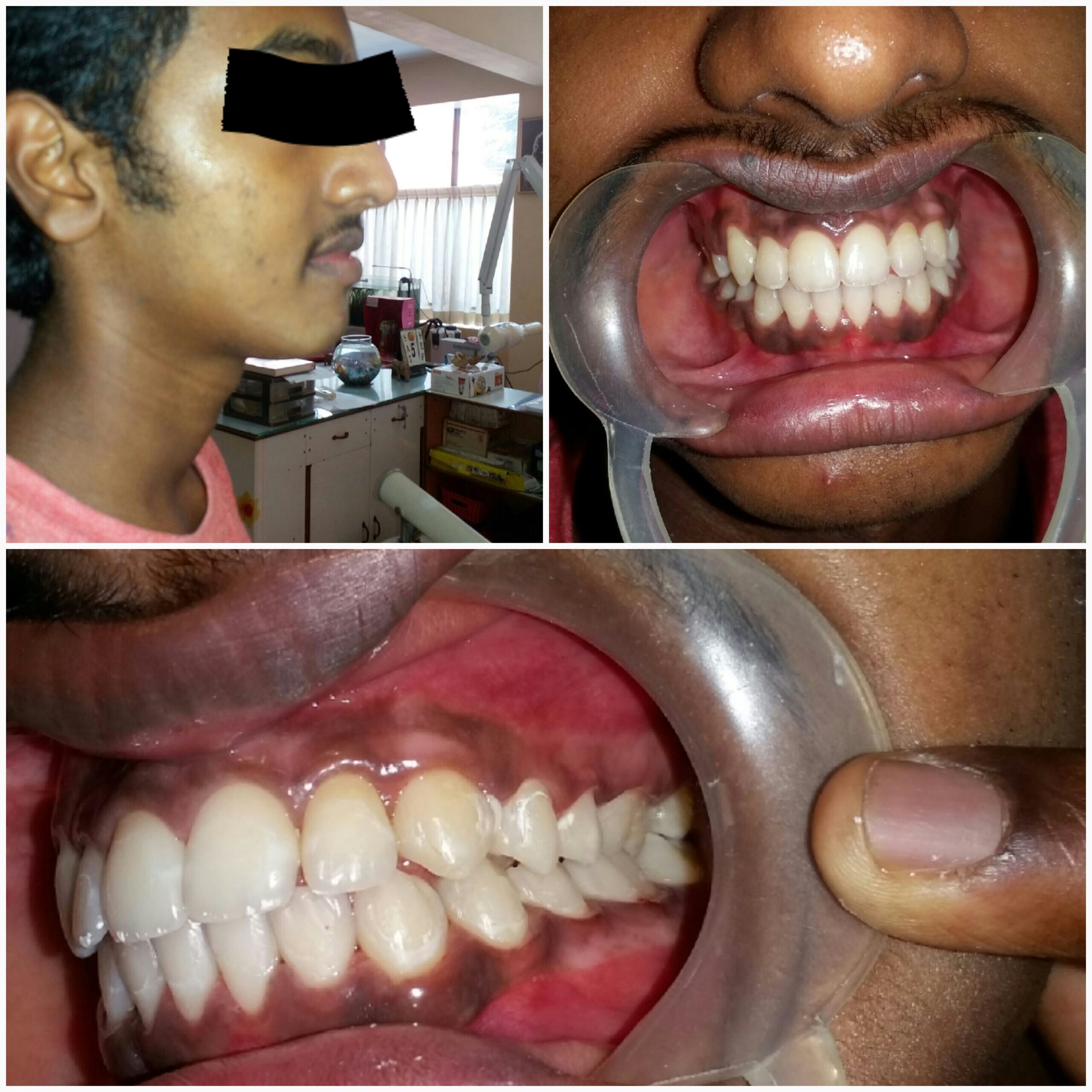 After treatment