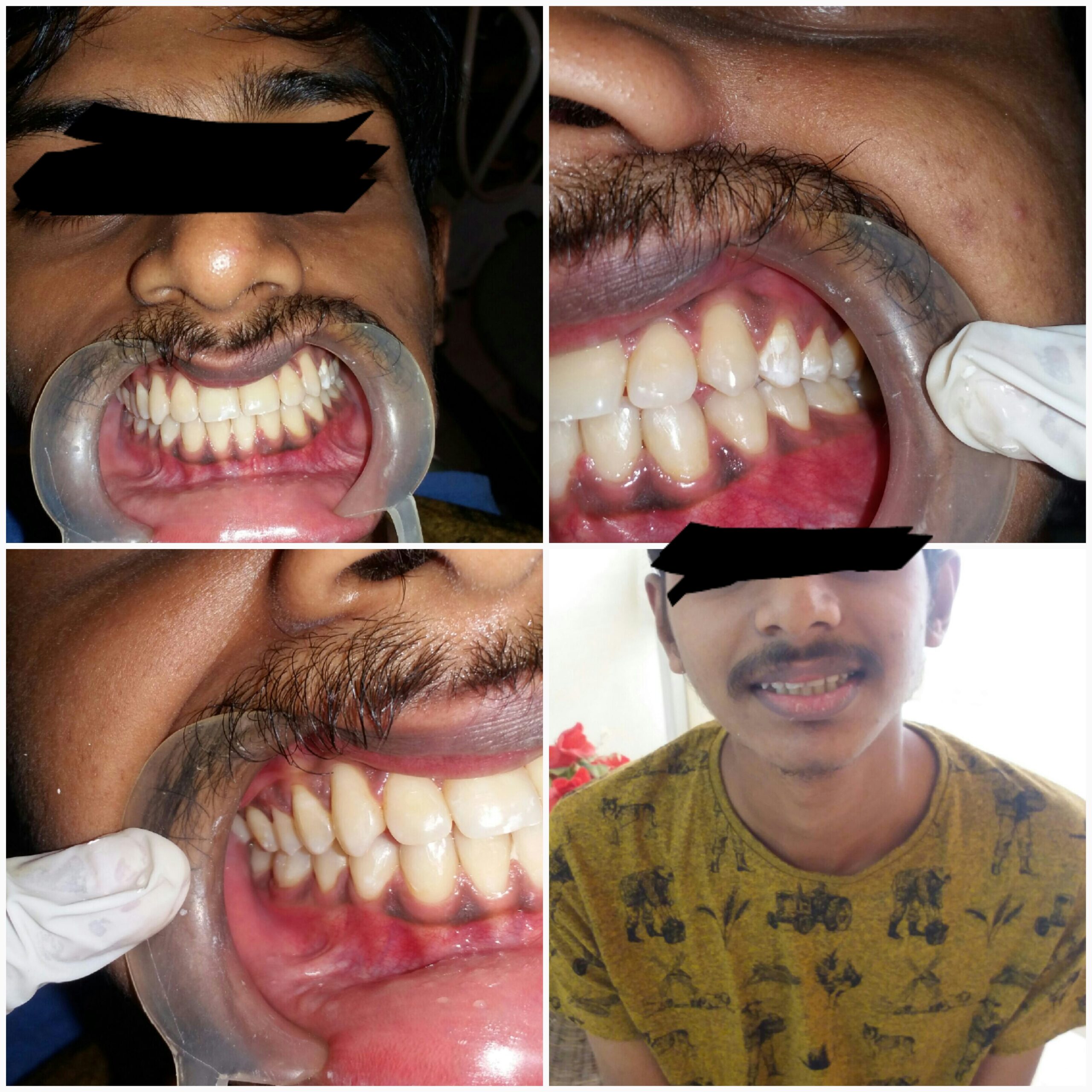After treatment