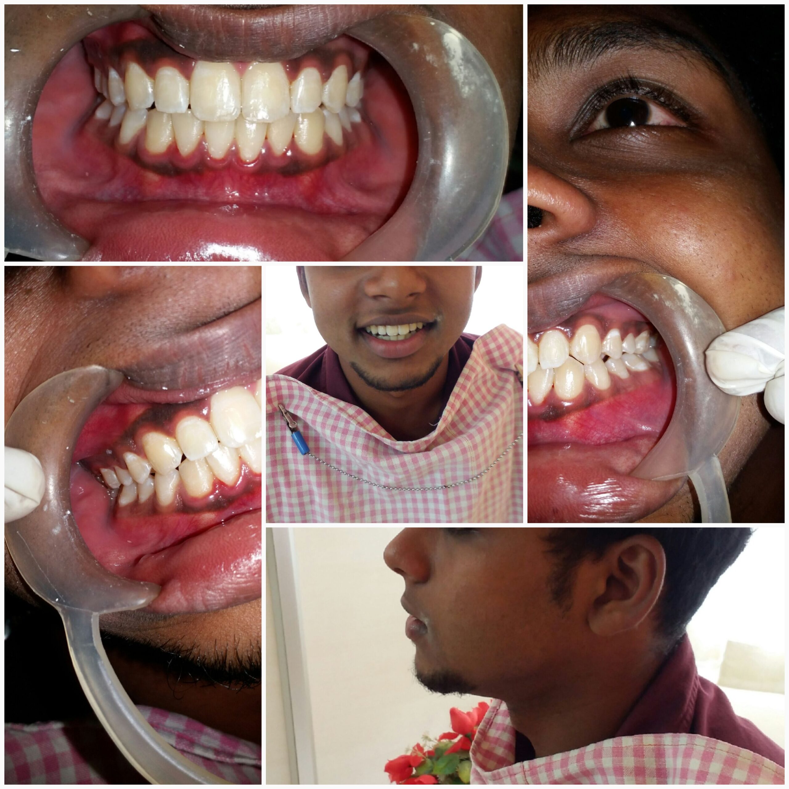 After treatment