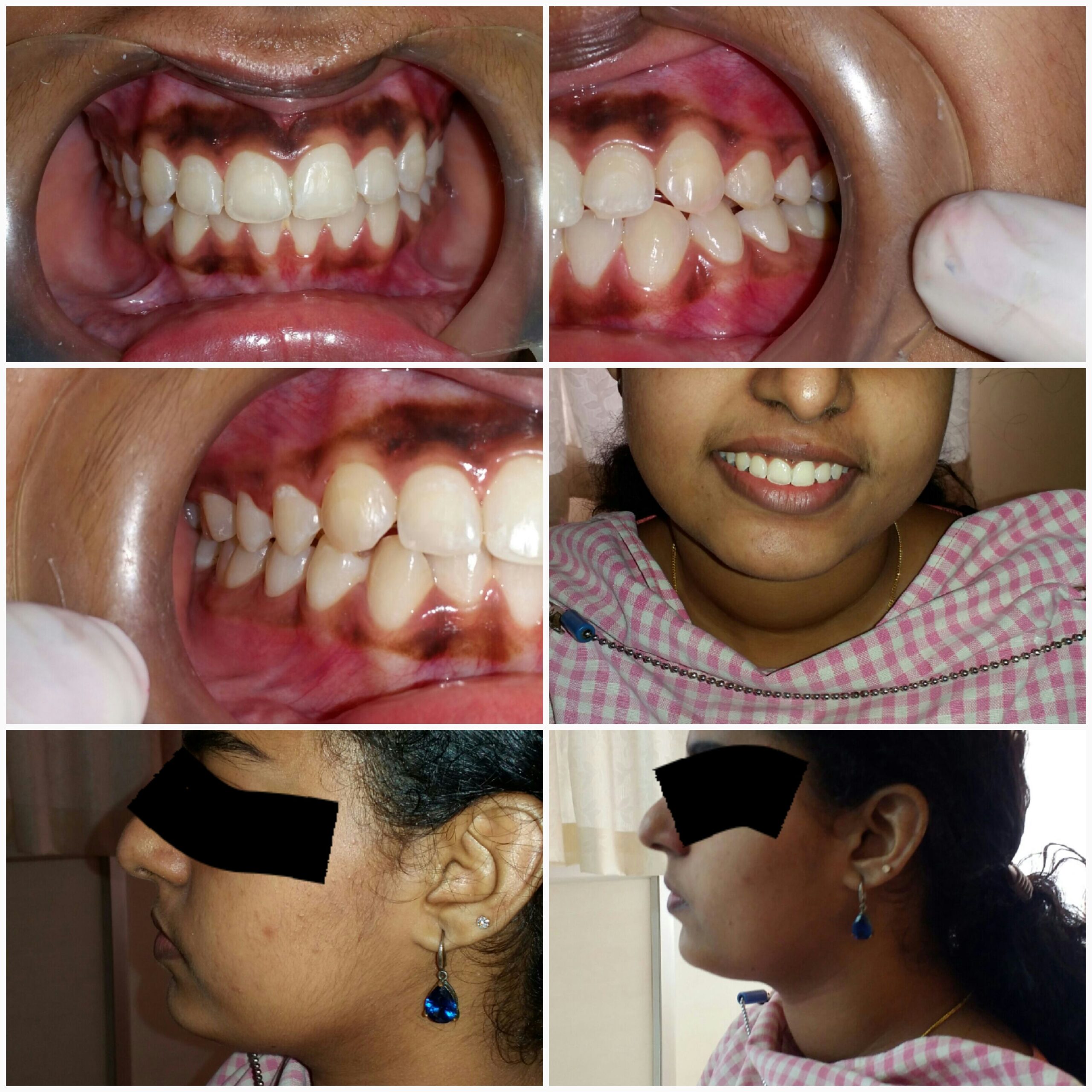 After treatment