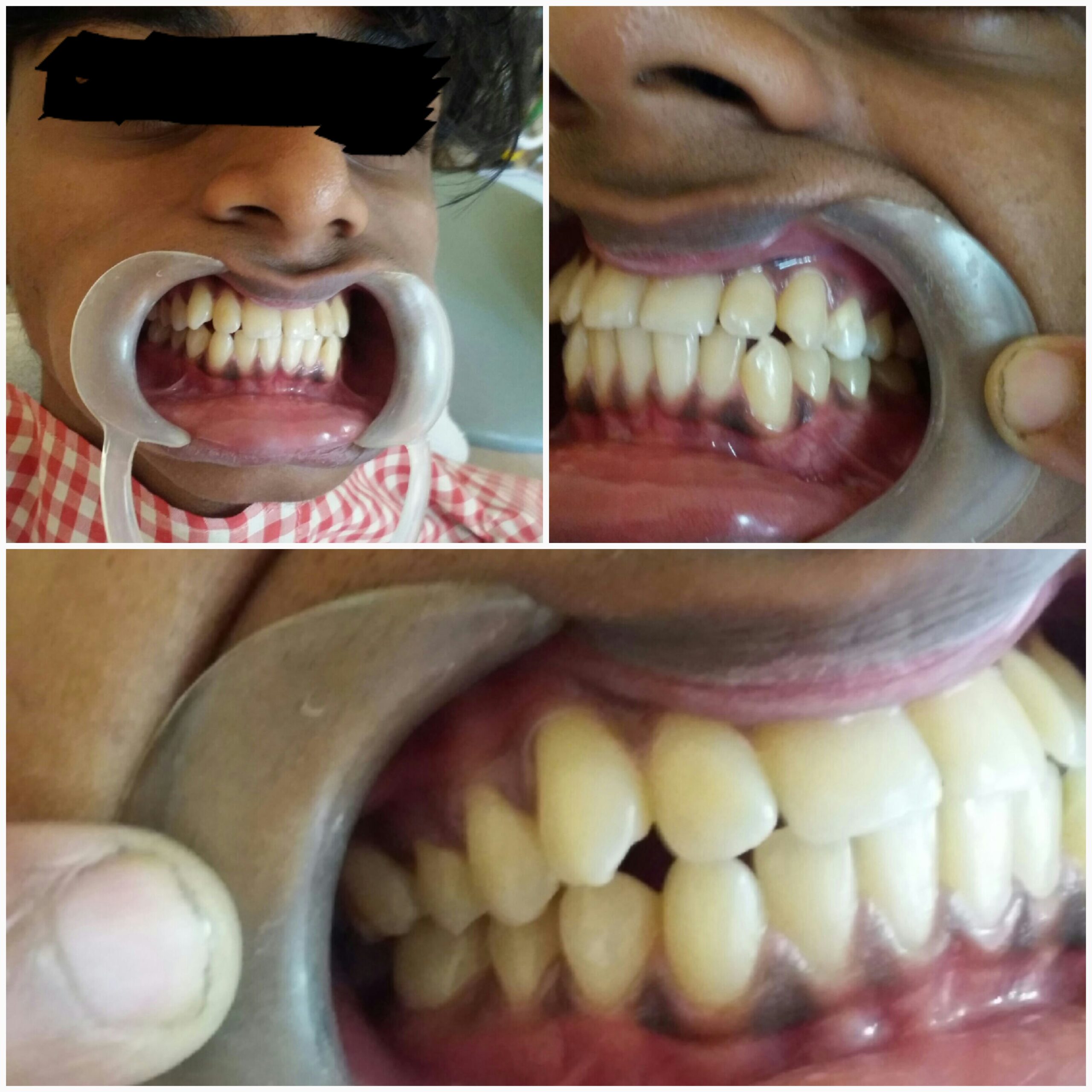 Before treatment