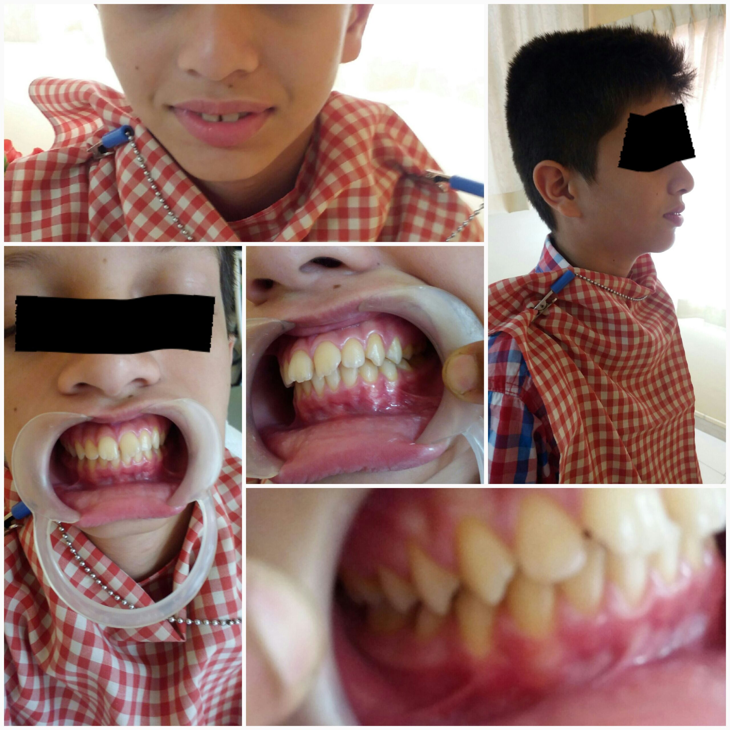 Before treatment