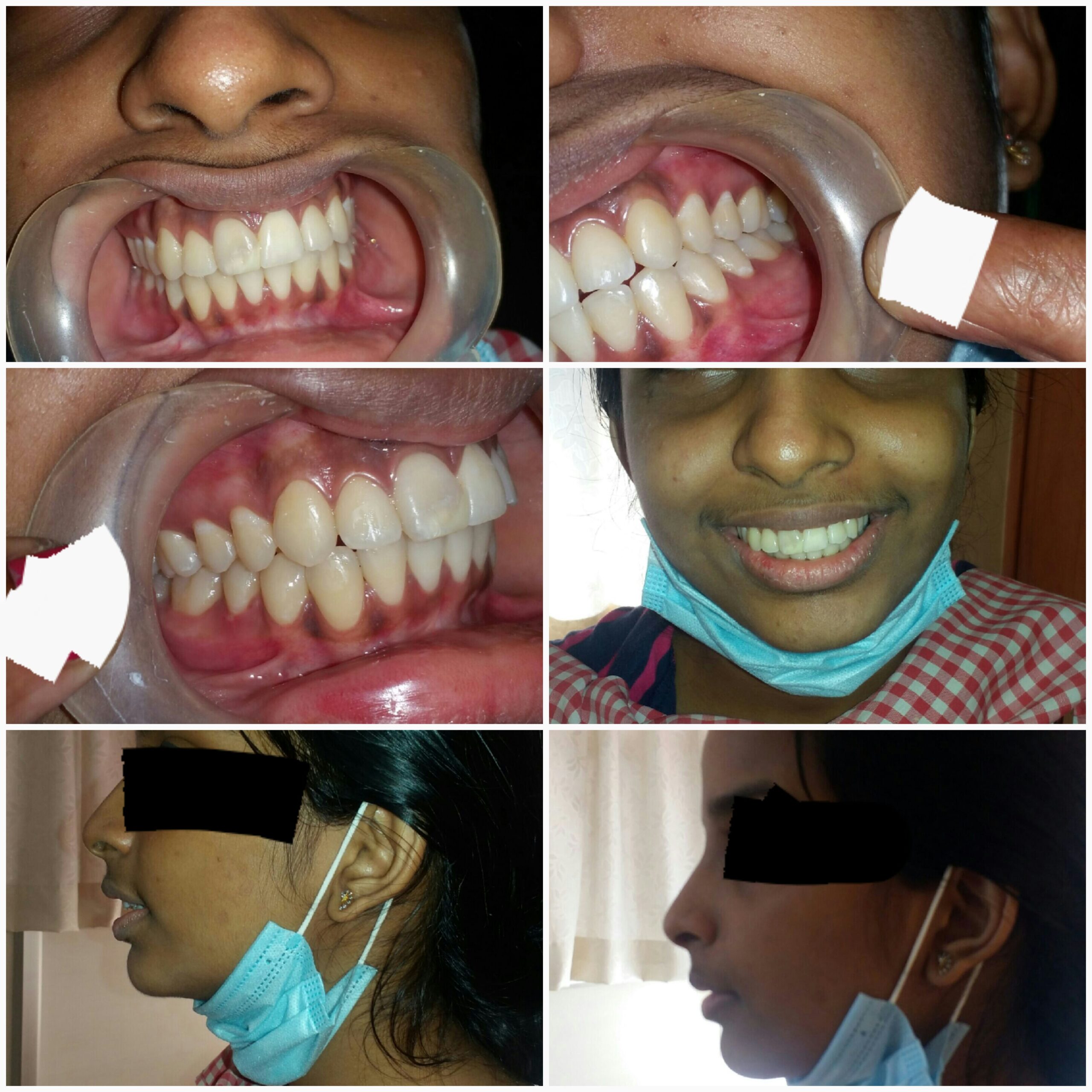 After treatment