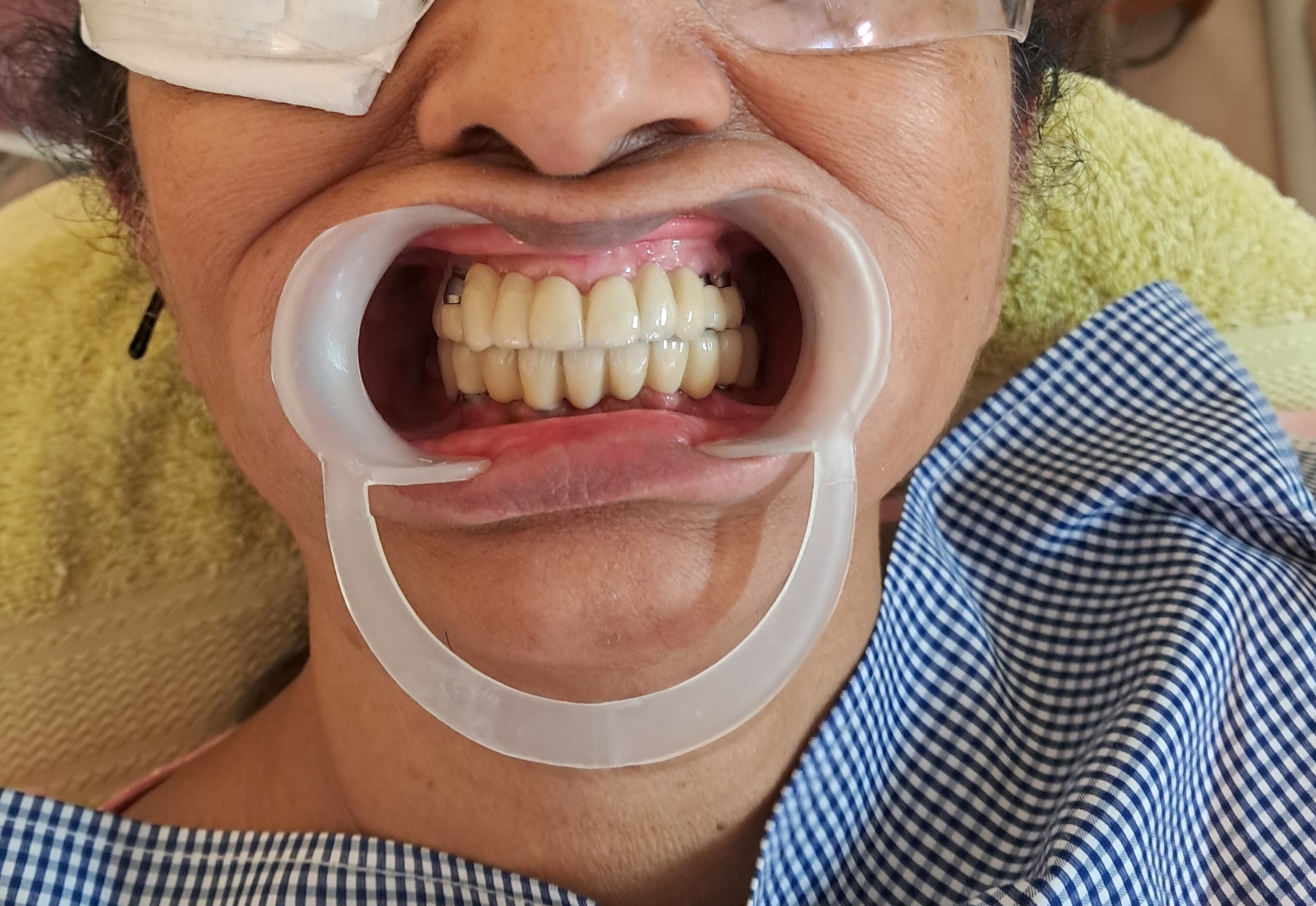 Before treatment