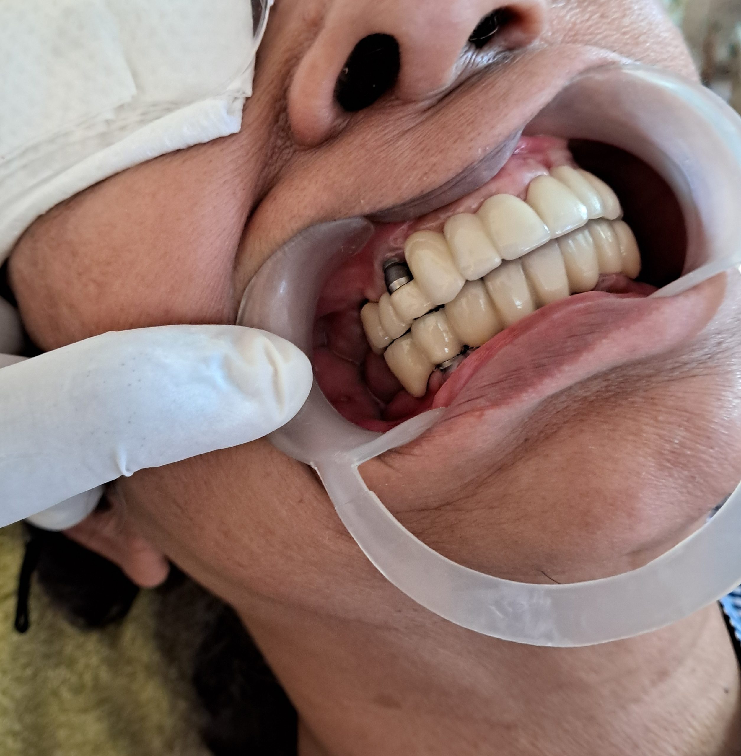 After treatment