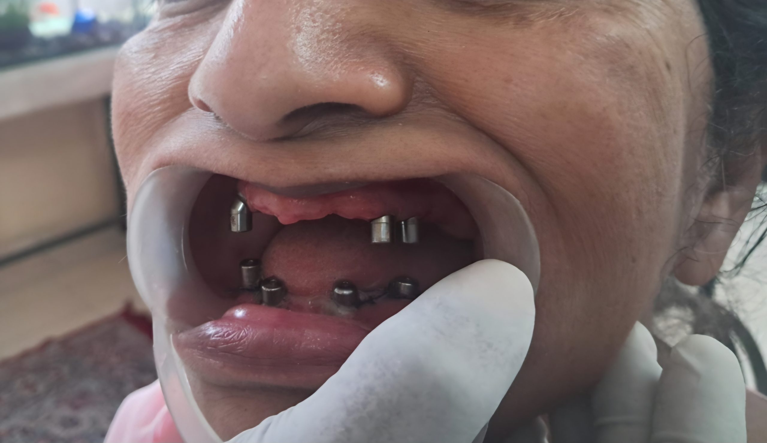 Before treatment