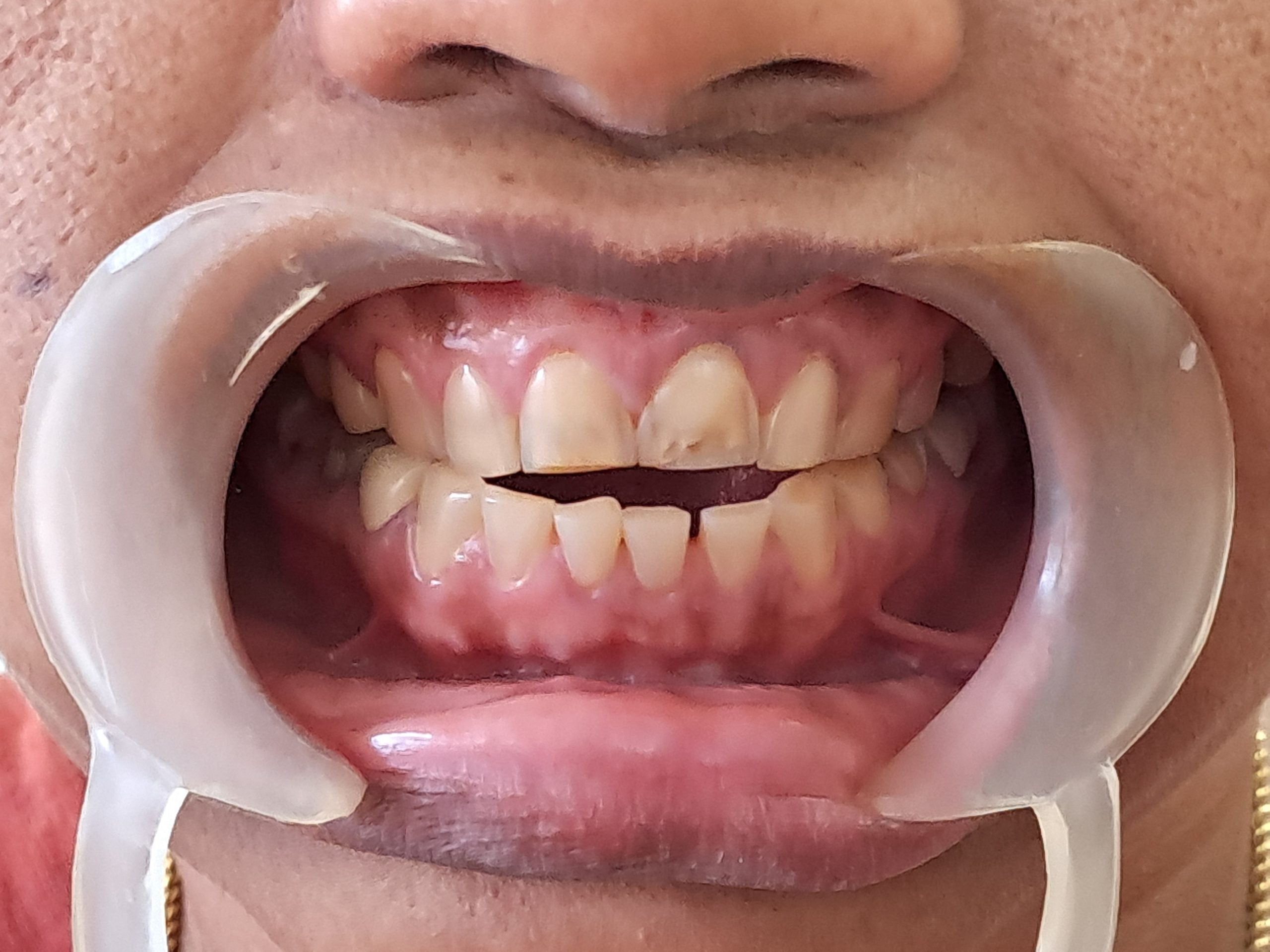 Before treatment
