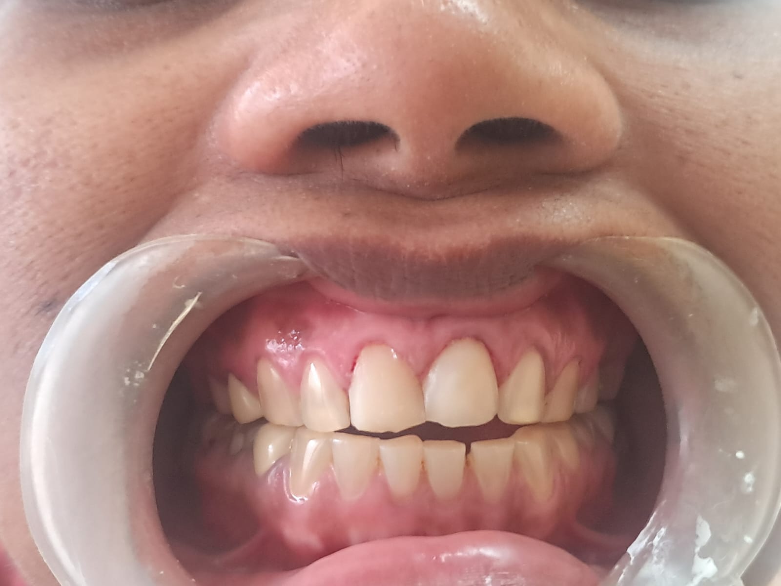 After treatment