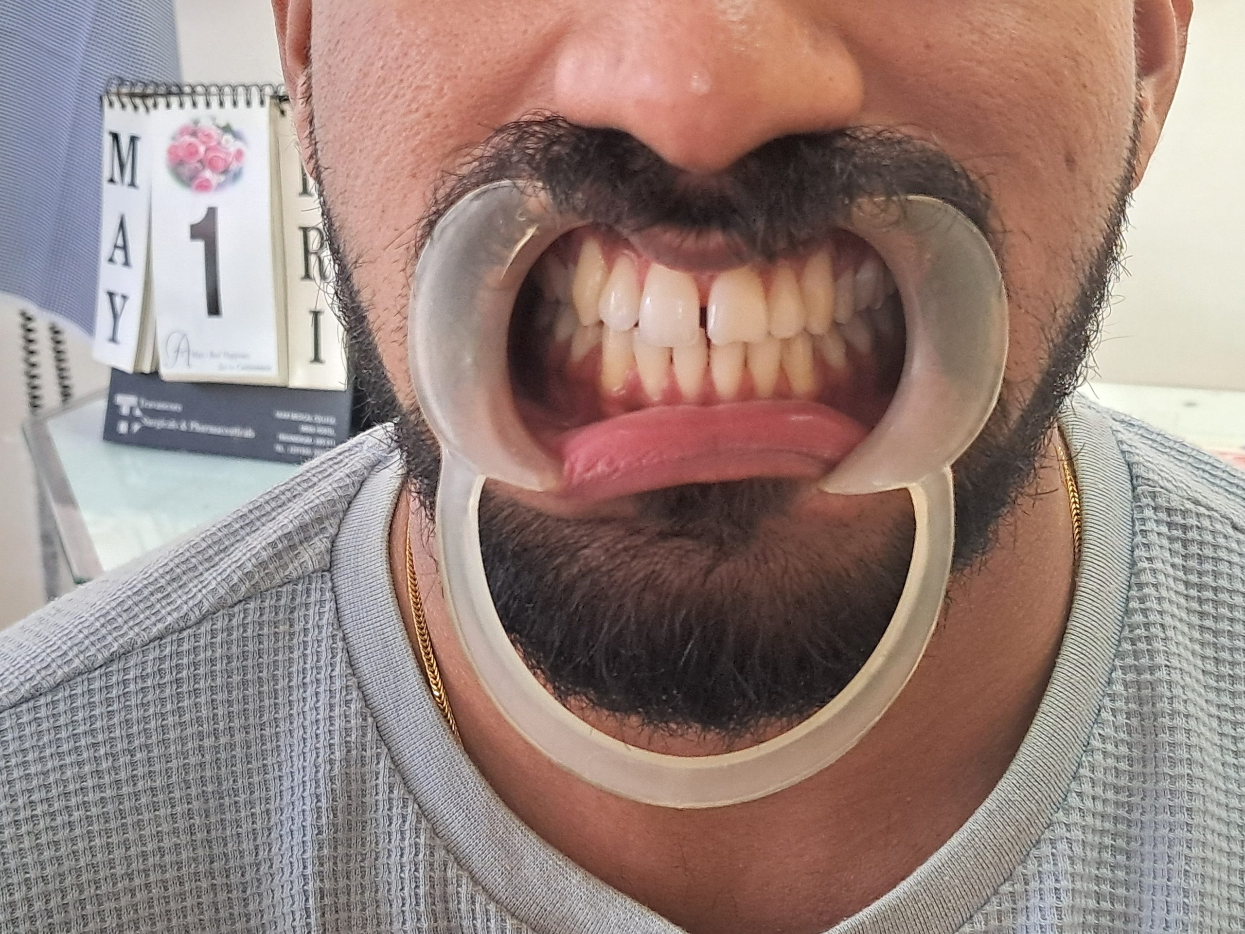 Before treatment