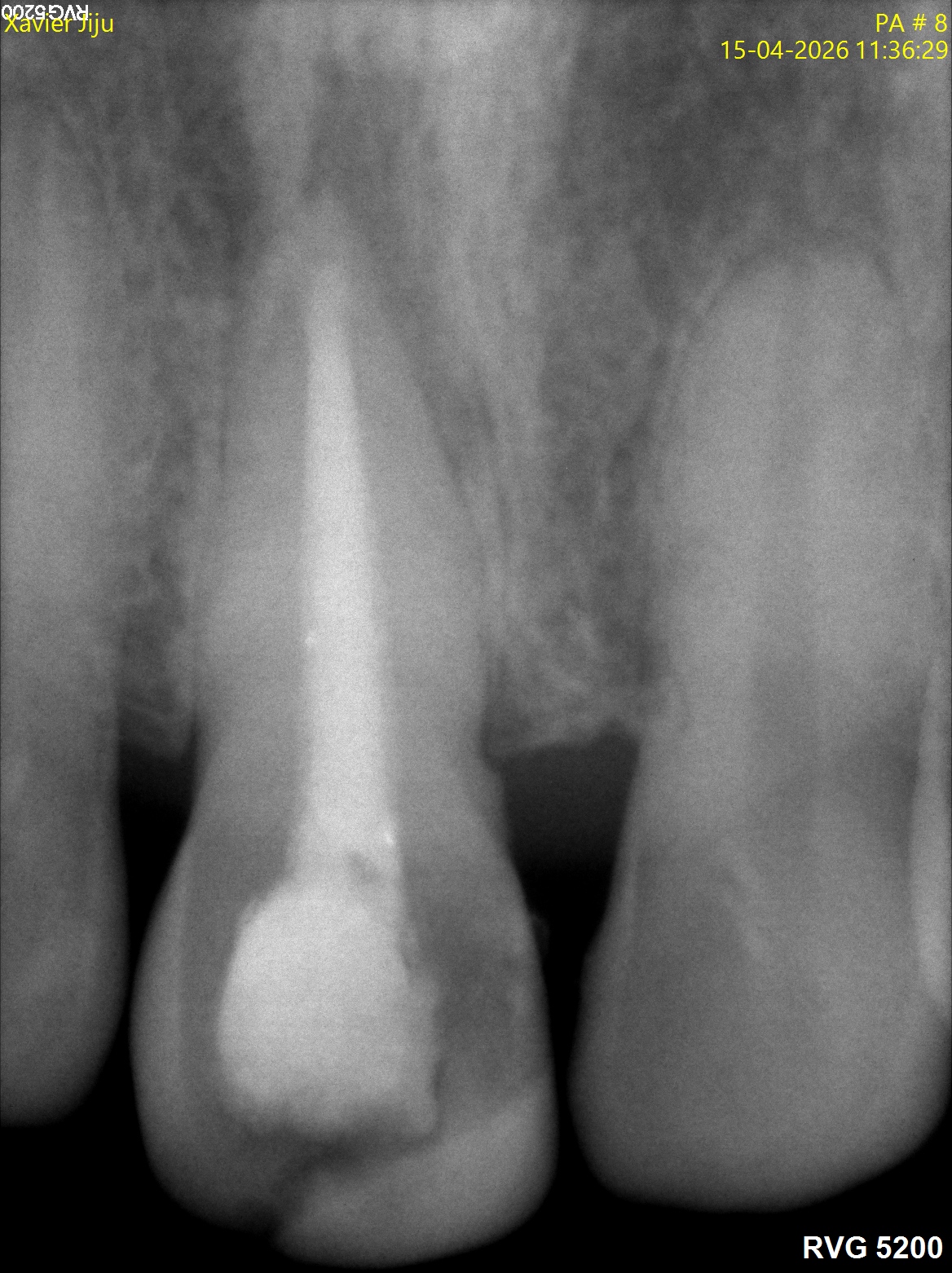After treatment