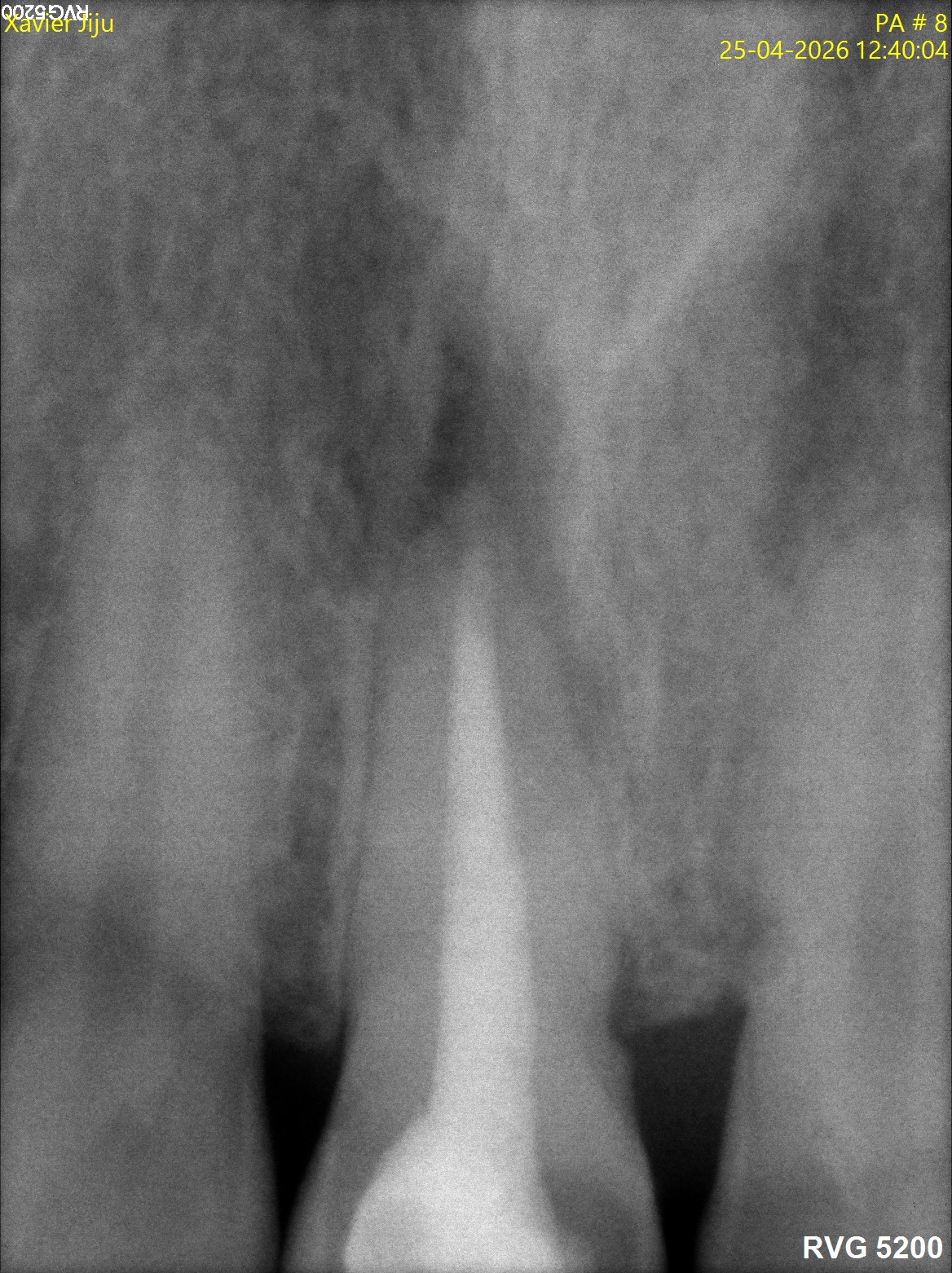Before treatment