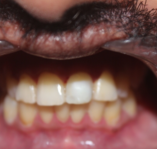 After treatment