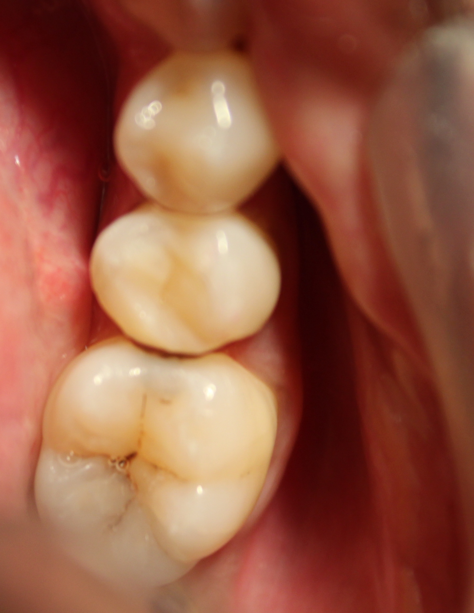 After treatment