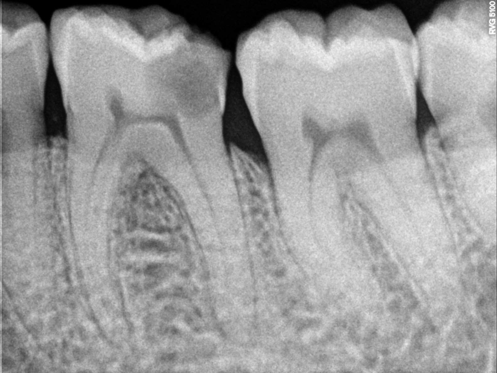 Before treatment
