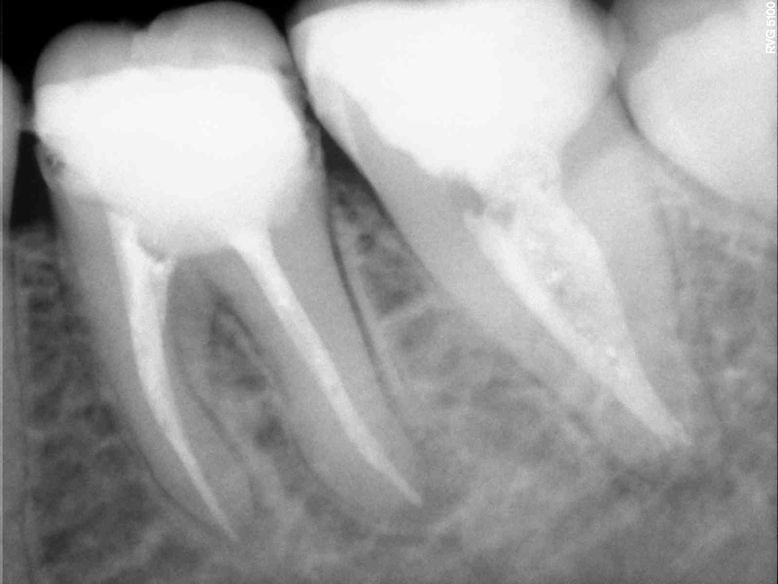 After treatment