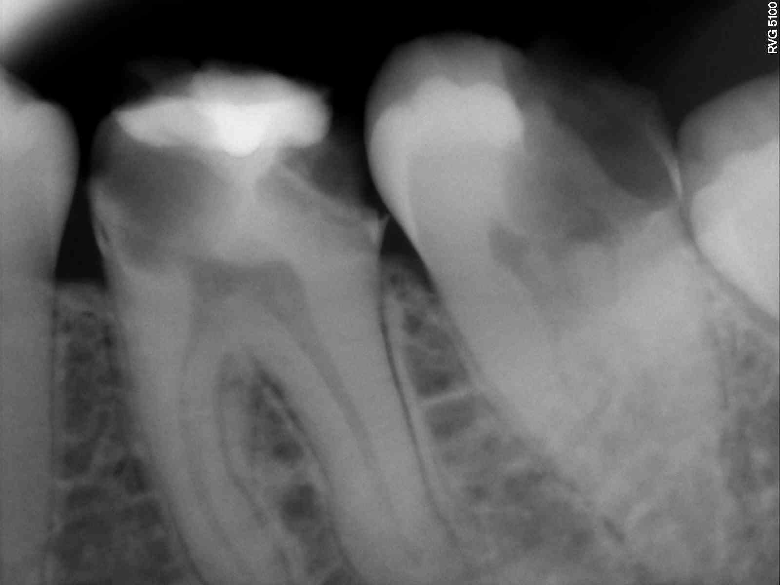 Before treatment