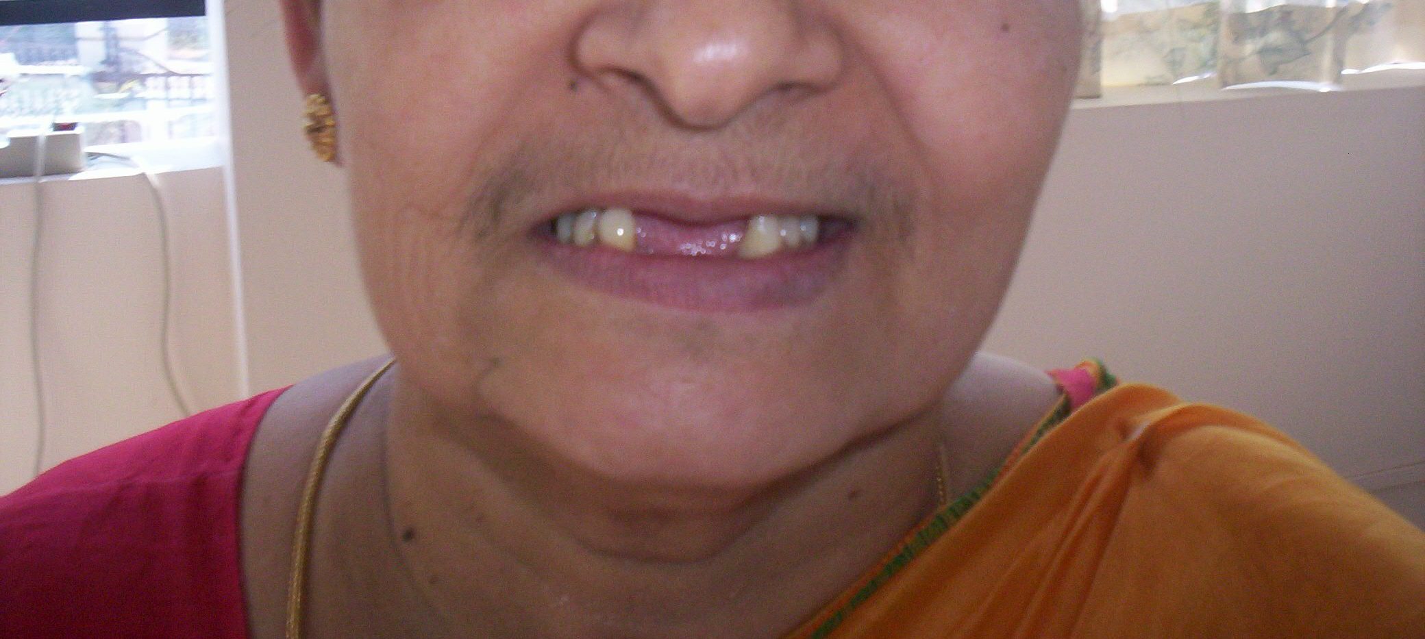 Before treatment
