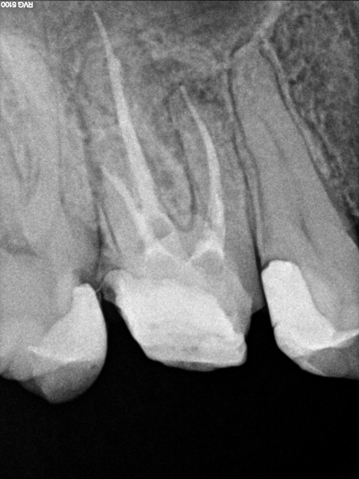 After treatment