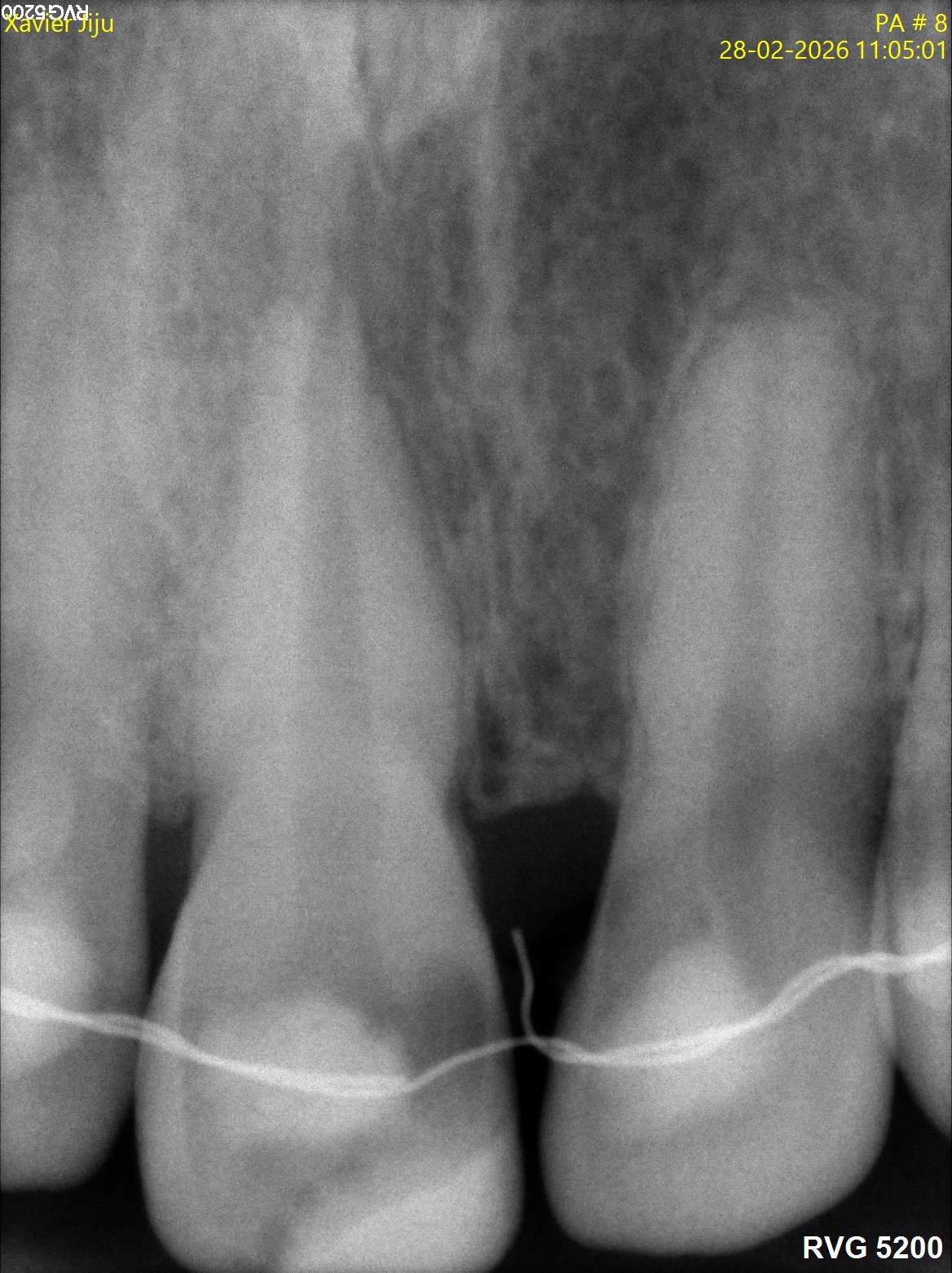 Before treatment