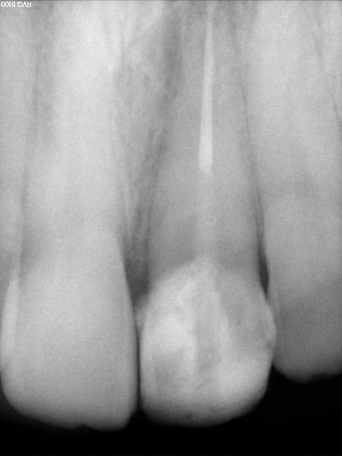 After treatment